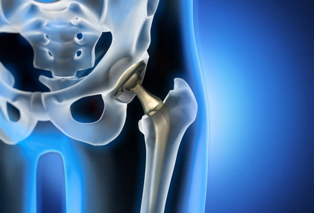 Artificial hip joint